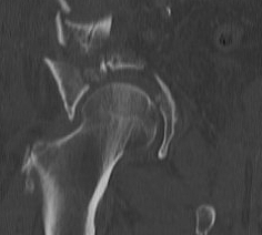 Acetabular Fracture Non Concentric 2